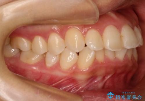 【非抜歯矯正】できる限り前歯を引っ込めたいの治療前