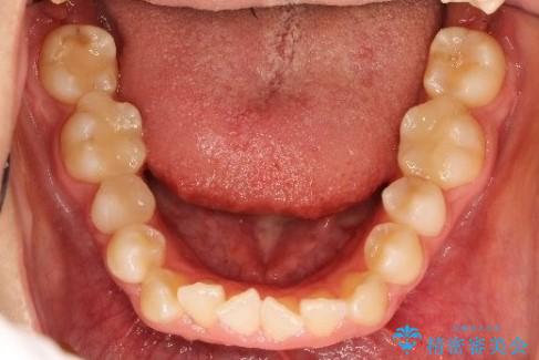 【非抜歯矯正】できる限り前歯を引っ込めたいの治療前