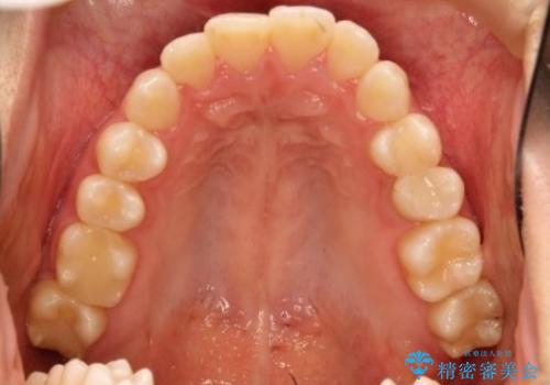 【非抜歯矯正】できる限り前歯を引っ込めたいの治療前