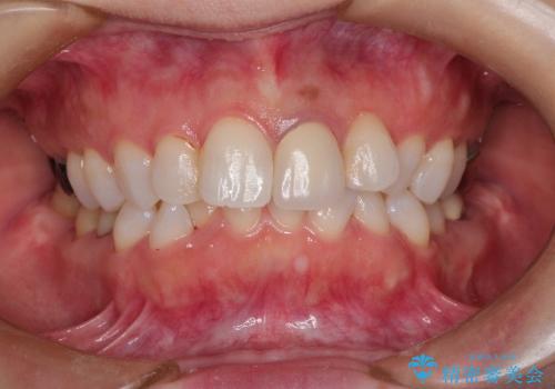 インビザラインによる非抜歯矯正　ガタガタな歯並びを整った歯並びへの治療前