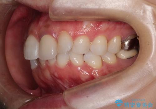 インビザラインによる非抜歯矯正 ガタガタな歯並びを整った歯並びへの治療前