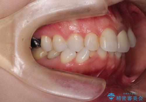 インビザラインによる非抜歯矯正 ガタガタな歯並びを整った歯並びへの治療前