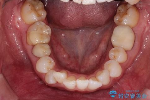 インビザラインによる非抜歯矯正 ガタガタな歯並びを整った歯並びへの治療前