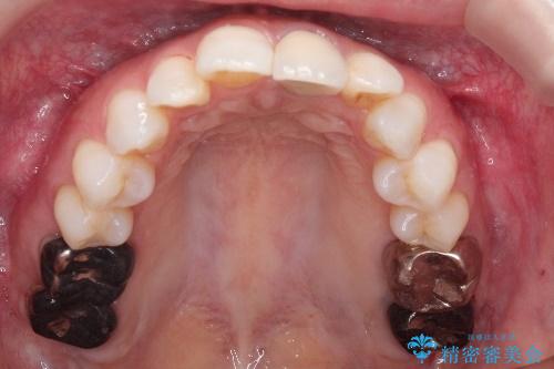 インビザラインによる非抜歯矯正 ガタガタな歯並びを整った歯並びへの治療前