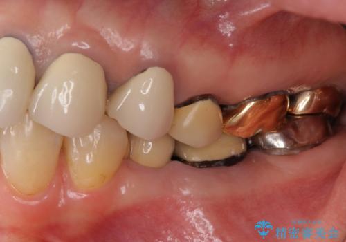 強い咬合力に対抗するメタルボンド補綴の症例 治療前