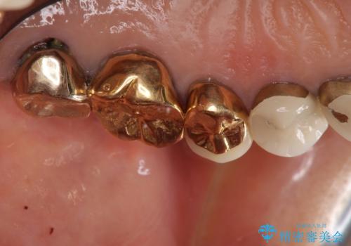 強い咬合力に対抗するメタルボンド補綴の治療前