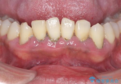 [ 非外科・歯石除去 ]  歯周初期治療による歯肉状態の改善の治療前