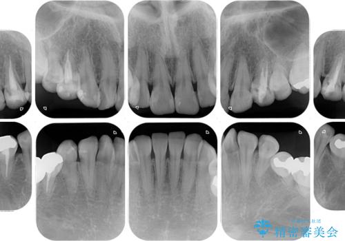 総合歯科治療　矯正治療と失活歯のセラミック補綴治療の治療前