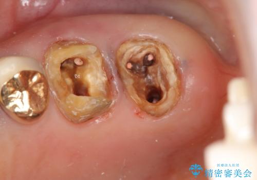 強い咬合力に対抗するメタルボンド補綴の治療中