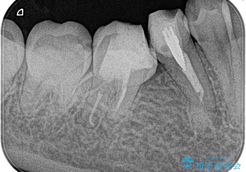 【湾曲根管】奥歯がズキズキ痛い の症例 治療後