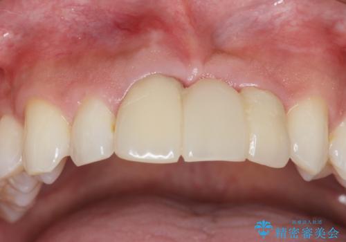 [前歯の歯根吸収]　前歯審美セラミックブリッジの製作の治療前