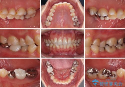 総合歯科治療　矯正治療と失活歯のセラミック補綴治療の治療前