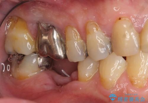 歯の破折 フルジルコニアブリッジ補綴の治療前