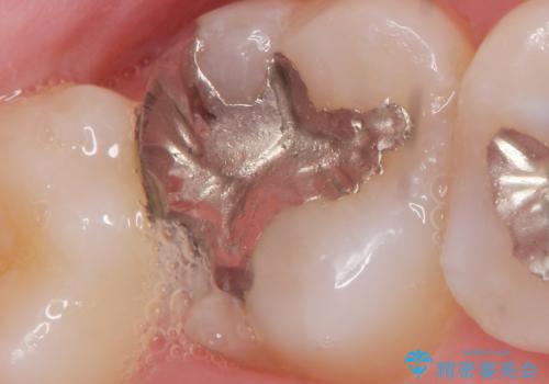 食べ物が詰まる 親知らずが原因の虫歯再発の治療前