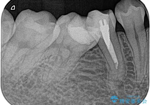 【湾曲根管】奥歯がズキズキ痛い の治療前