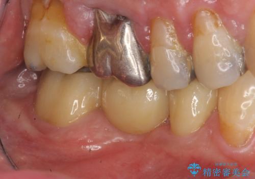 歯の破折 フルジルコニアブリッジ補綴の治療後