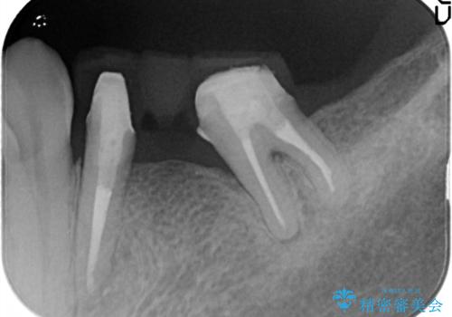 金属のかぶせ物をセラミックへ 根管治療からの再治療の治療中