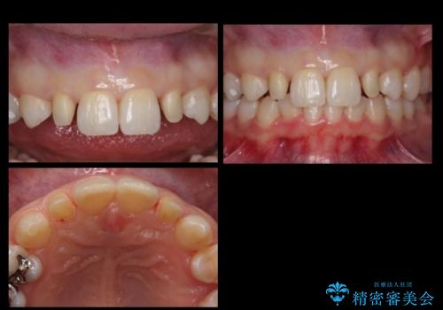 前歯を整えたい 小さい前歯がある 矯正・セラミック併用で美しく インビザラインでも抜歯矯正できますの治療中
