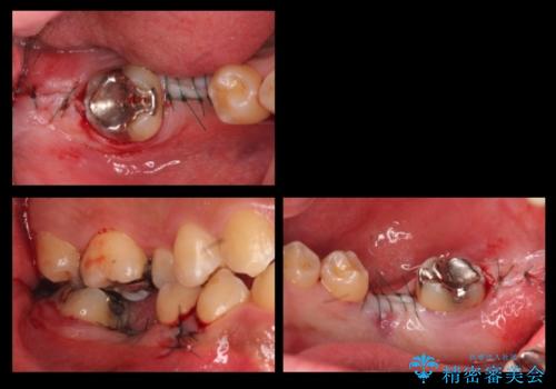初めてのインプラント 手術は怖いので、寝ている間に終わりたいの治療中