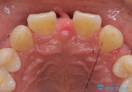 オールセラミッククラウン　部分矯正とセラミックによる前歯部の見た目の改善の治療前