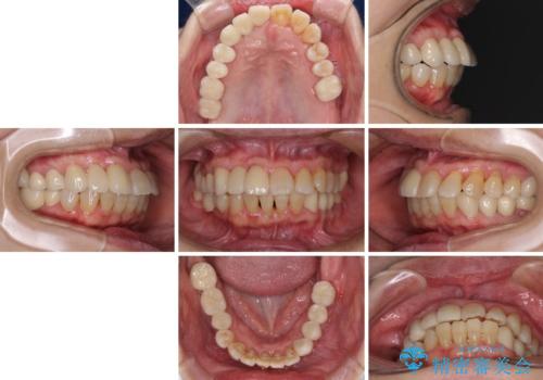 歯周病改善のための総合歯科治療の治療後