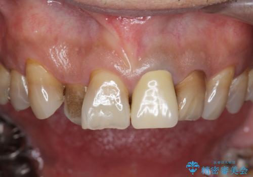 [前歯　セラミック治療]  すぐに前歯が取れる きちんと治療して欲しいの治療前