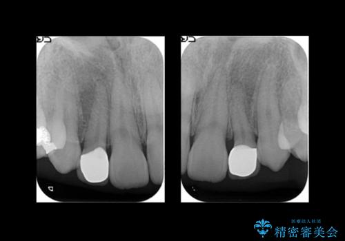 前歯を整えたい 小さい前歯がある 矯正・セラミック併用で美しく インビザラインでも抜歯矯正できますの治療後
