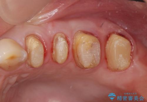 放置した虫歯 根管治療 フルジルコニアクラウンの治療中