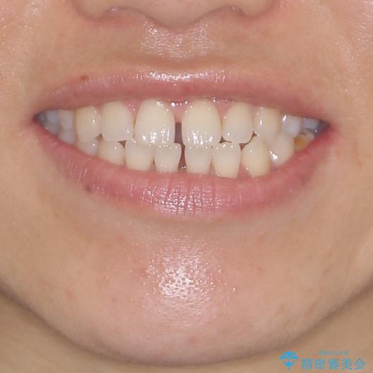 隙間の空いた前歯を治したい　インビザライン矯正治療の治療前（顔貌）