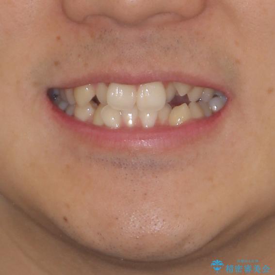 八重歯を治したい　目立たないワイヤー装置での抜歯矯正の治療前（顔貌）