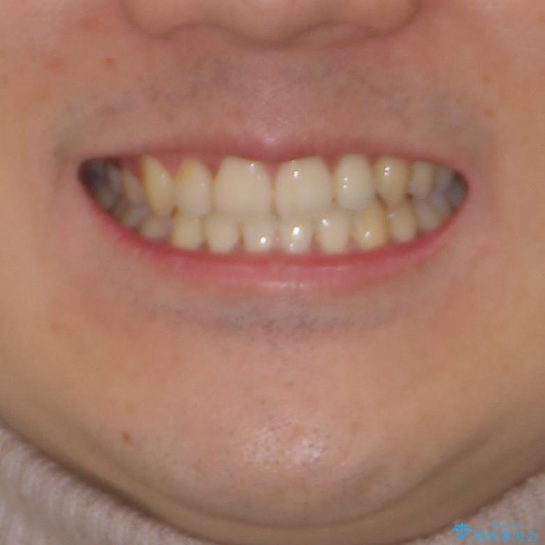 八重歯を治したい　目立たないワイヤー装置での抜歯矯正の治療後（顔貌）