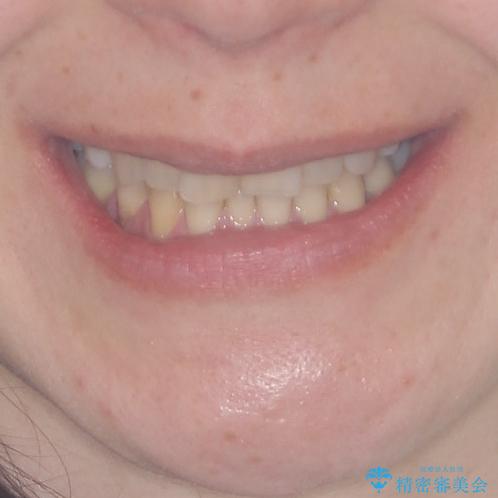 矯正の後戻りの改善と銀歯をセラミックにの治療前（顔貌）