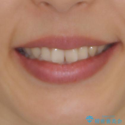 隙間だらけの歯列をきれいに　インビザライン矯正とセラミック補綴治療の治療前（顔貌）