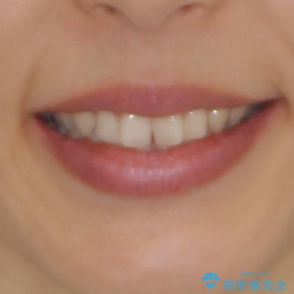 隙間だらけの歯列をきれいに インビザライン矯正とセラミック補綴治療の治療前(顔貌)