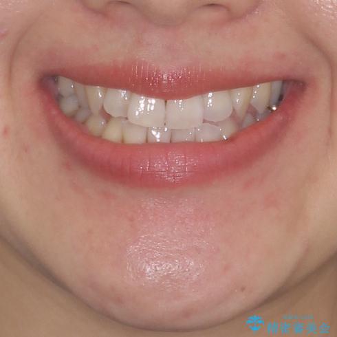 前歯のデコボコ インビザラインによる矯正治療の治療前(顔貌)