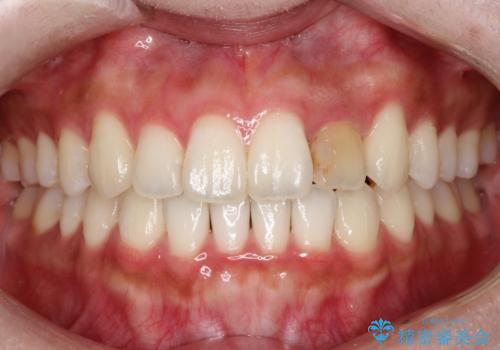 前歯の変色 オールセラミッククラウンの治療前