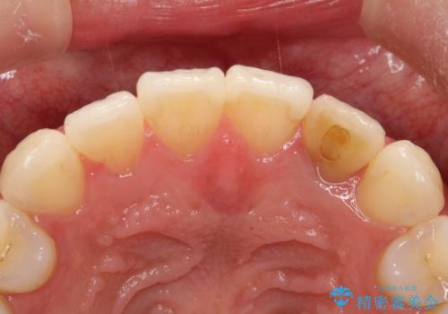 前歯の変色 オールセラミッククラウンの治療前