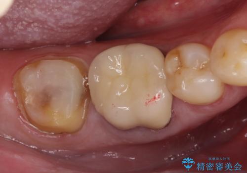 虫歯の治療 ゴールドクラウンの治療中