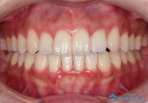 前歯の変色 オールセラミッククラウンの治療後