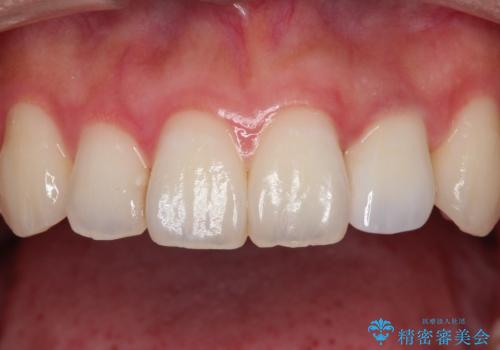 前歯の変色 オールセラミッククラウンの治療後