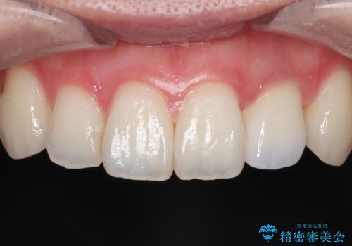 前歯の変色 オールセラミッククラウンの治療後