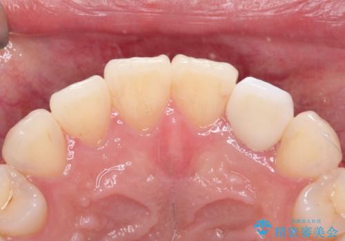 前歯の変色 オールセラミッククラウンの治療後