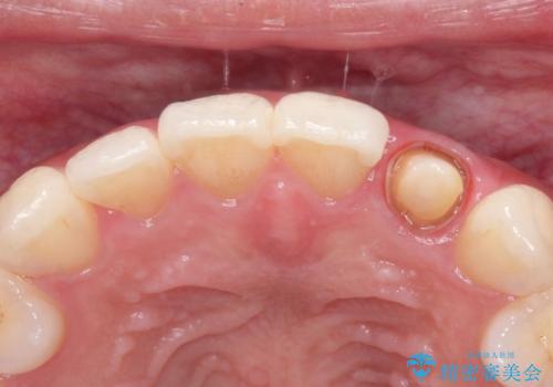 前歯の変色 オールセラミッククラウンの治療中