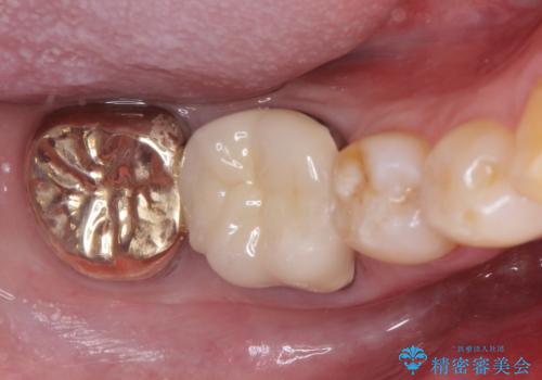 虫歯の治療　ゴールドクラウン