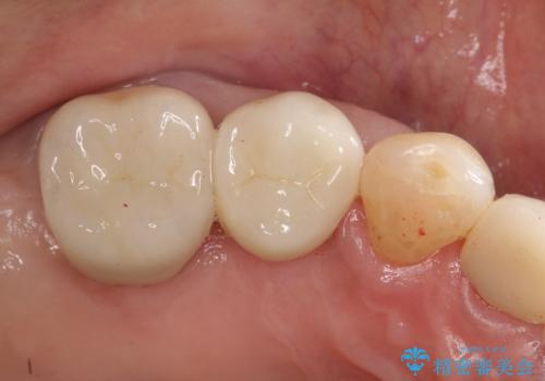 歯周病の進行した歯の抜歯。オールセラミッククラウンの治療後