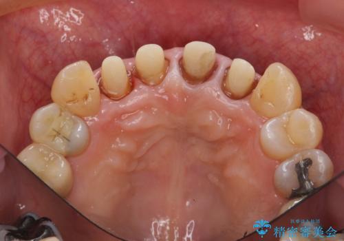 老朽化した前歯のセラミック治療やりかえの治療中