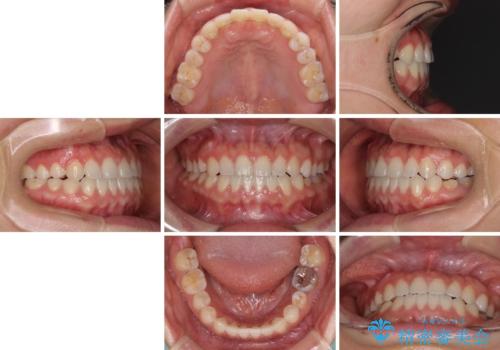 隙間の空いた前歯を治したい インビザライン矯正治療の治療後