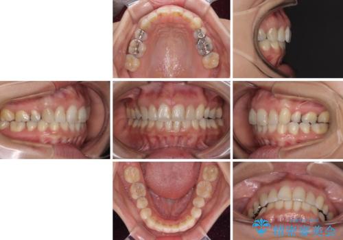 前歯の突出を軽減 インビザラインによる抜歯矯正の治療後