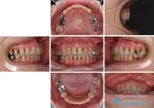閉じにくい口元を改善したい ワイヤー装置での抜歯矯正の治療後
