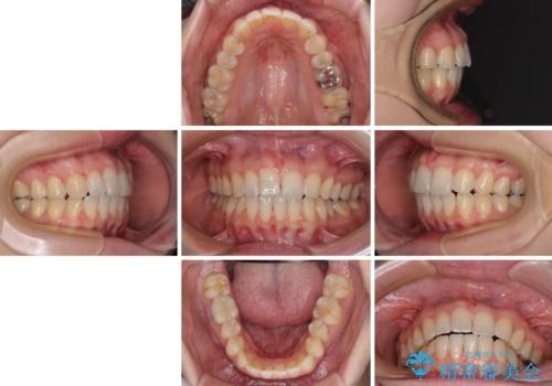 気になる上の歯を改善 インビザライン矯正の治療後